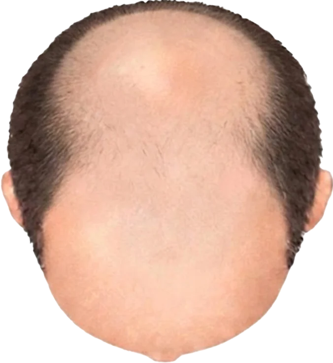 Balding Stage b9