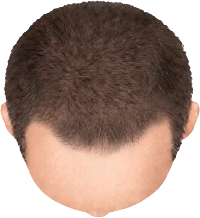 Balding Stage f1-b1