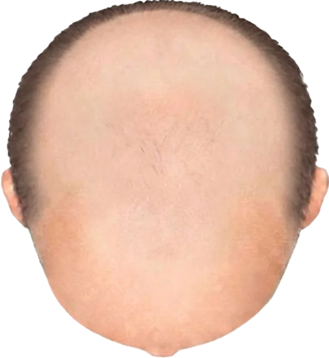 Balding Stage f1-b10