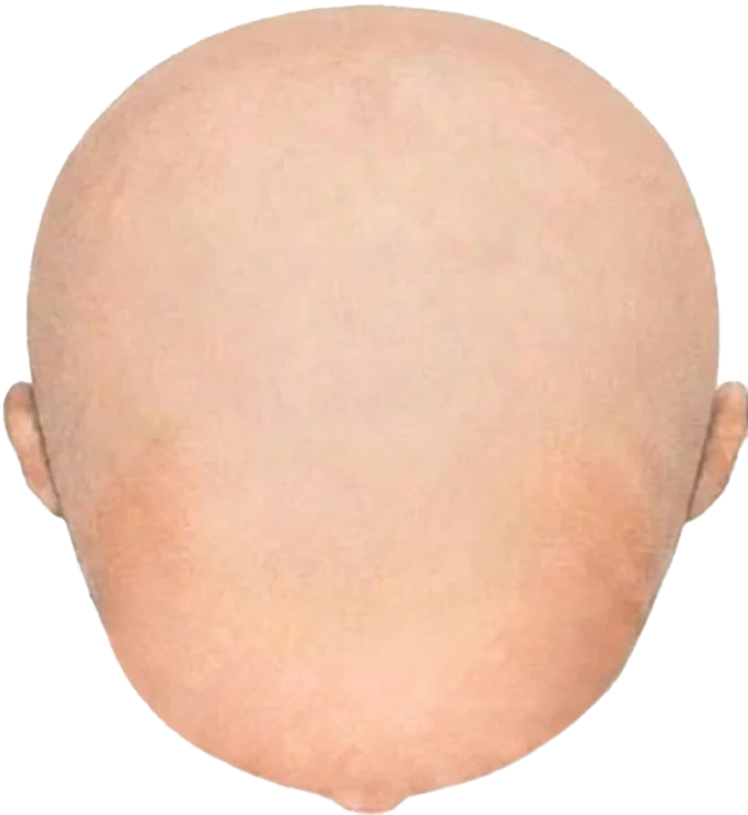 Balding Stage b11
