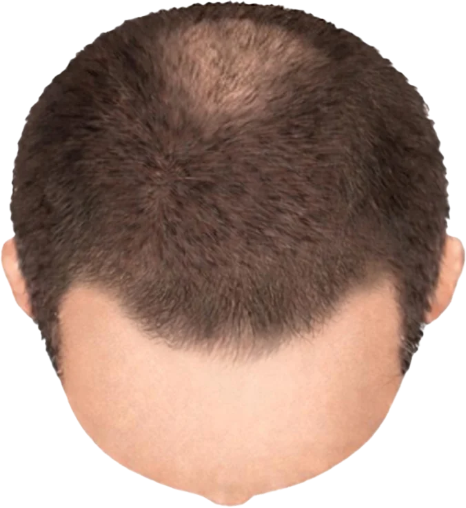 Balding Stage f1-b2