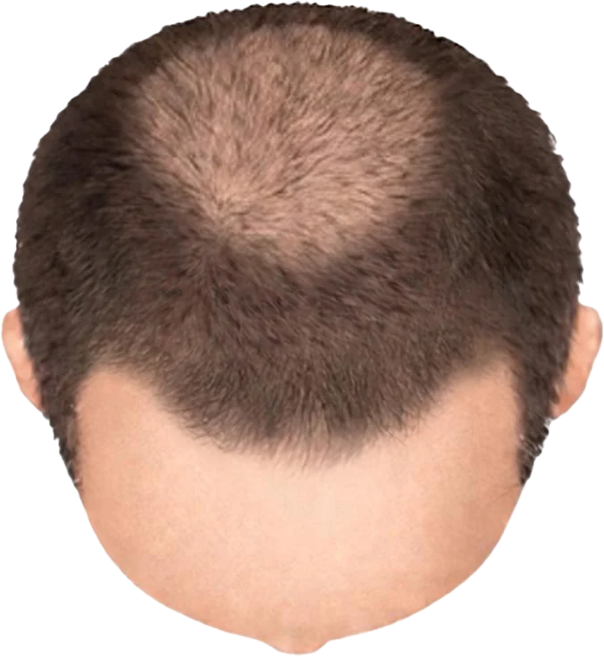 Balding Stage f1-b3