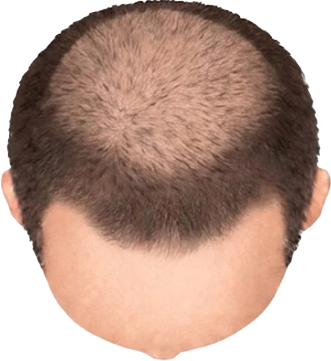 Balding Stage f1-b4