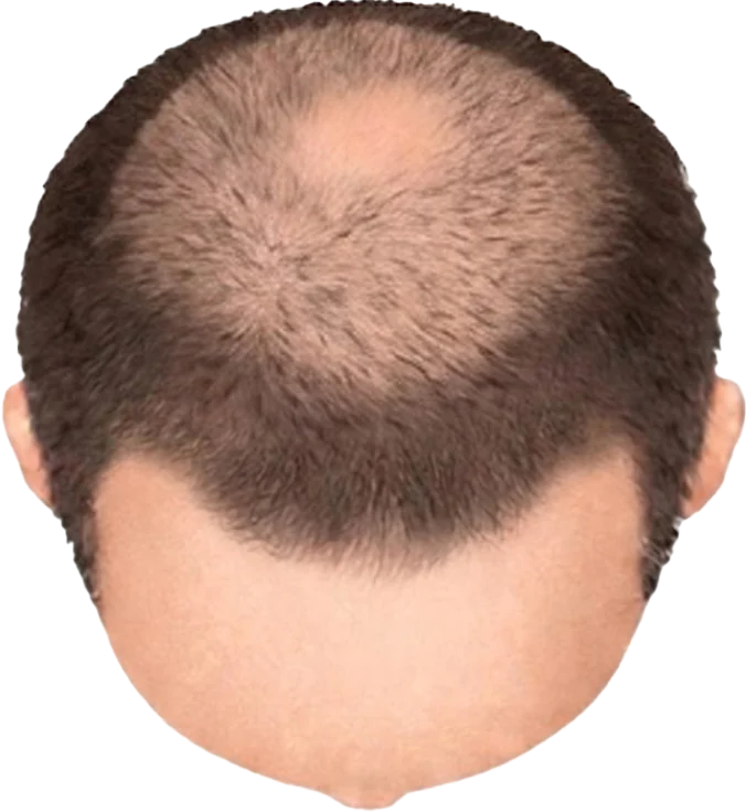 Balding Stage f1-b5