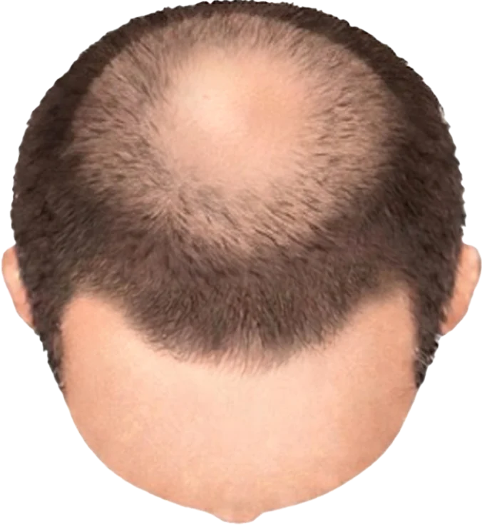 Balding Stage f1-b6