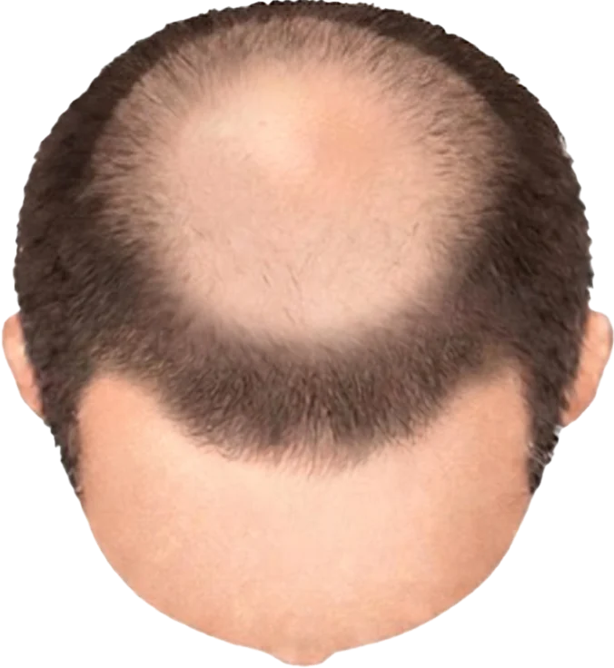 Balding Stage f1-b7