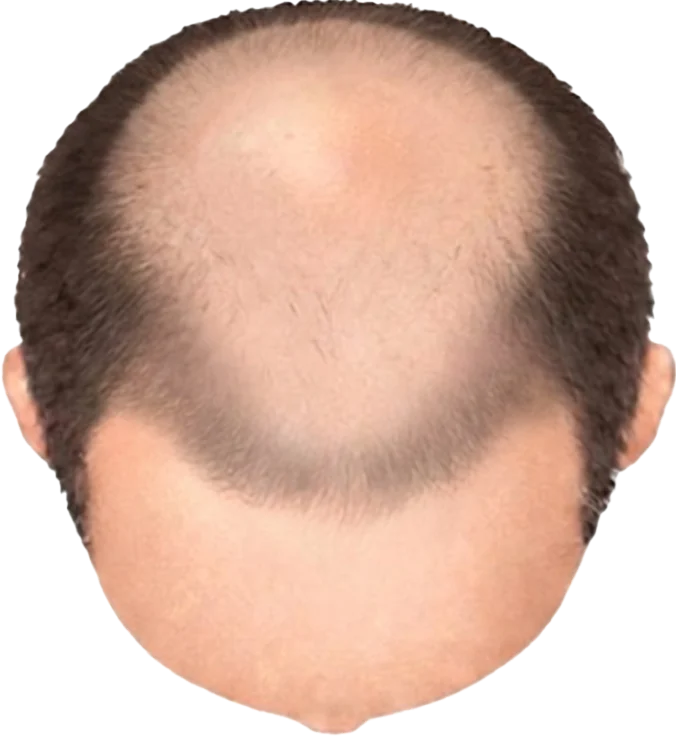 Balding Stage f1-b8