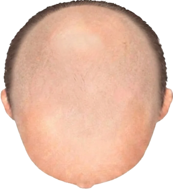 Balding Stage f10-b10