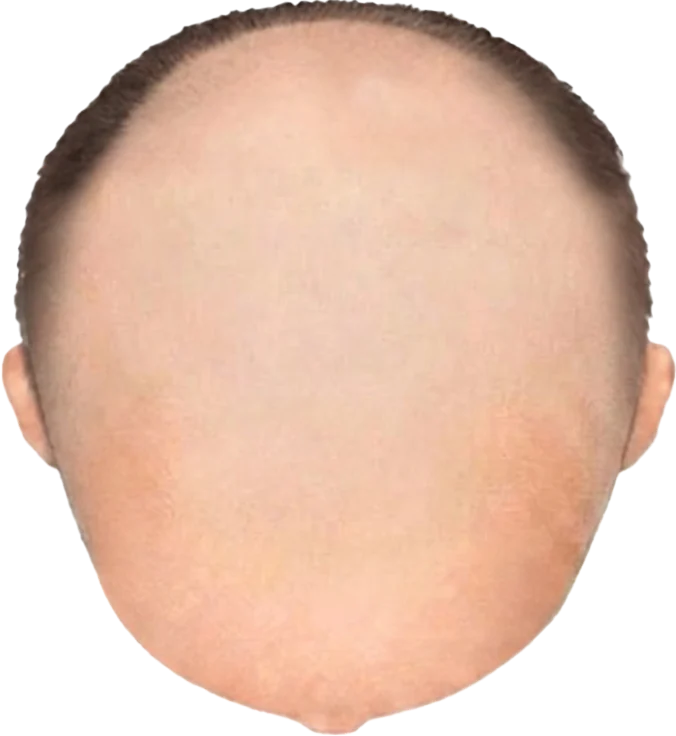 Balding Stage f10-b9