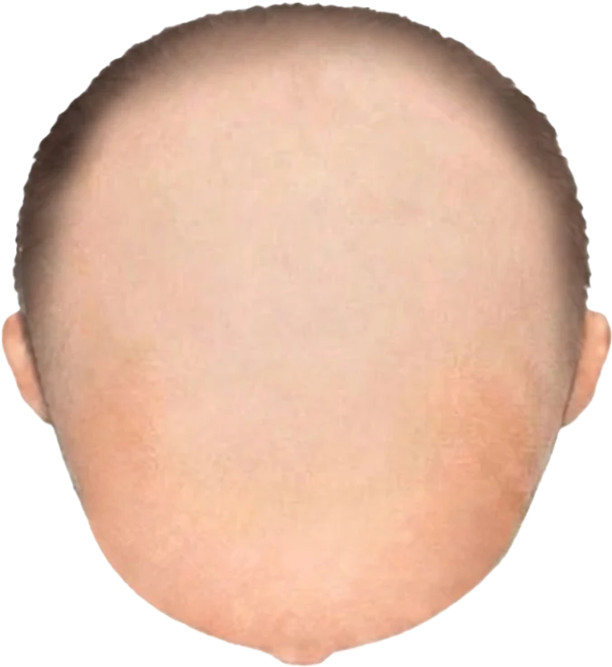 Balding Stage f10