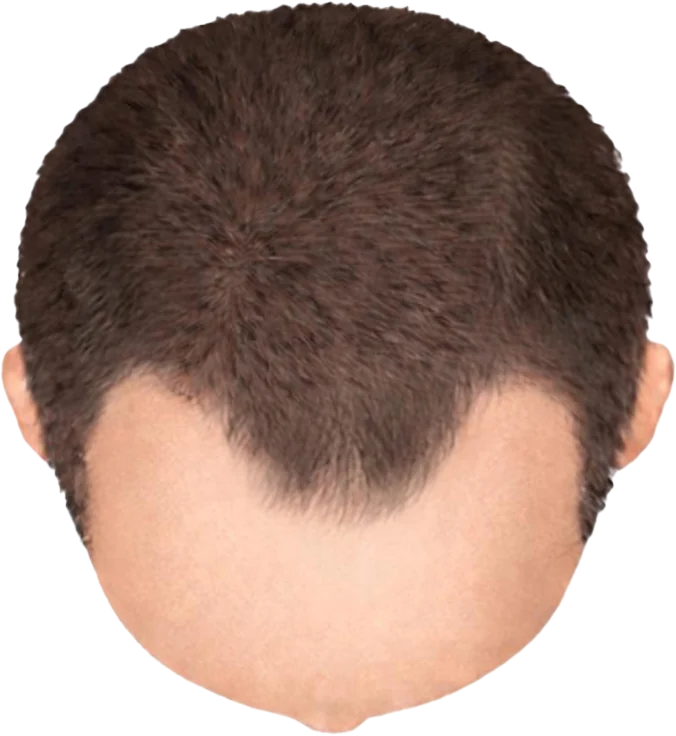 Balding Stage f2-b1