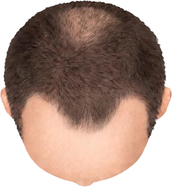 Balding Stage f2-b2