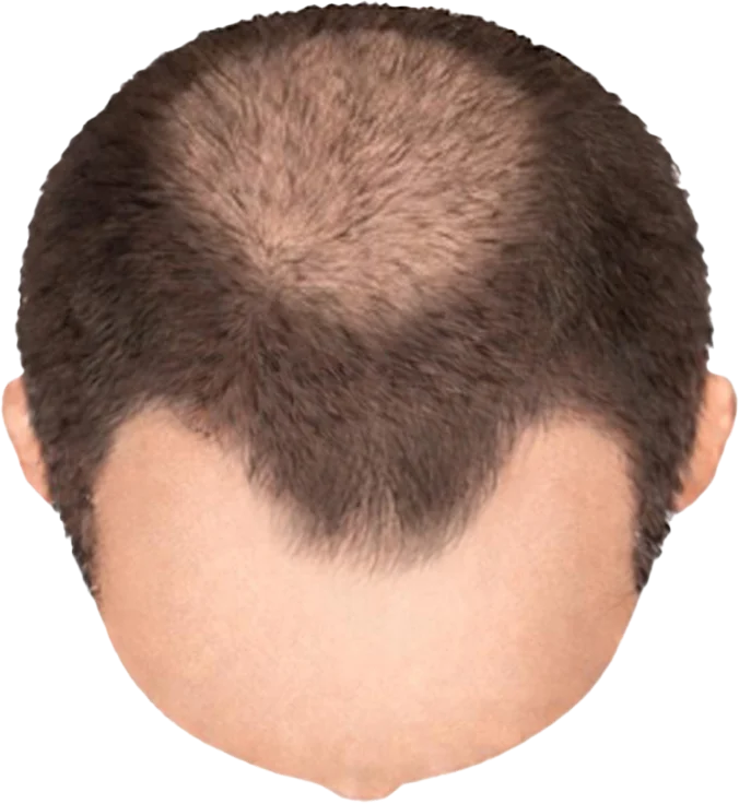 Balding Stage f2-b3