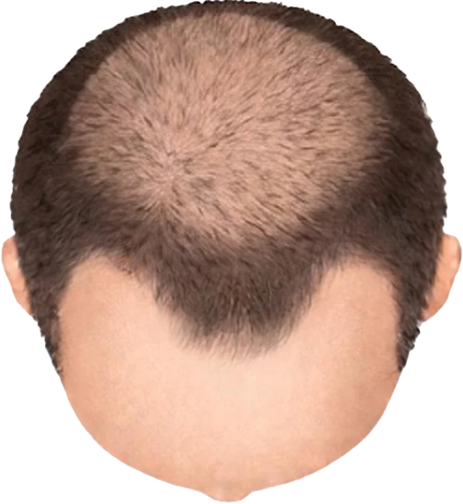 Balding Stage f2-b4