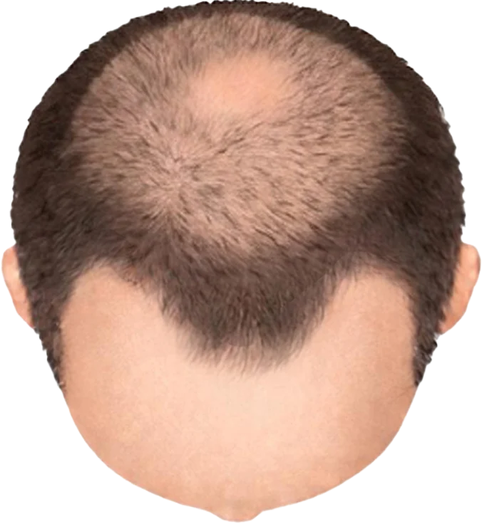 Balding Stage f2-b5