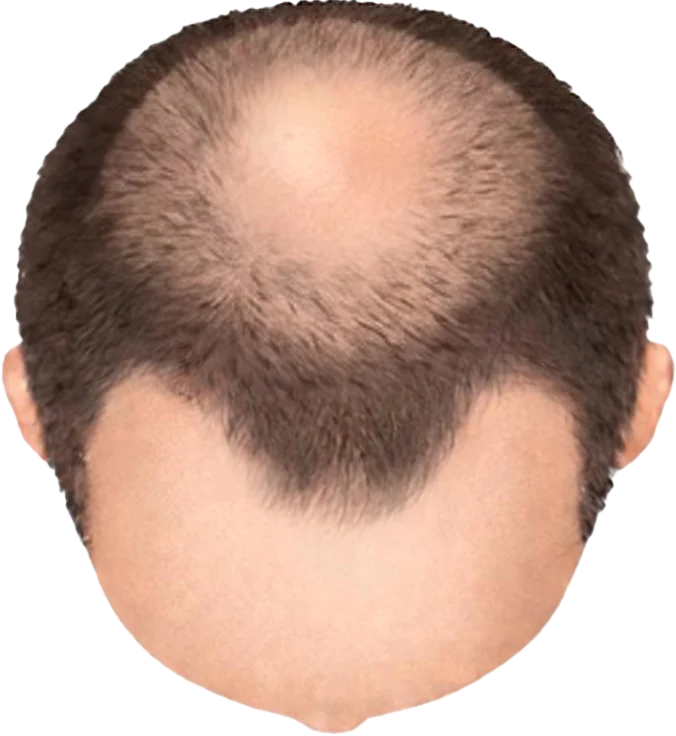 Balding Stage f2-b6