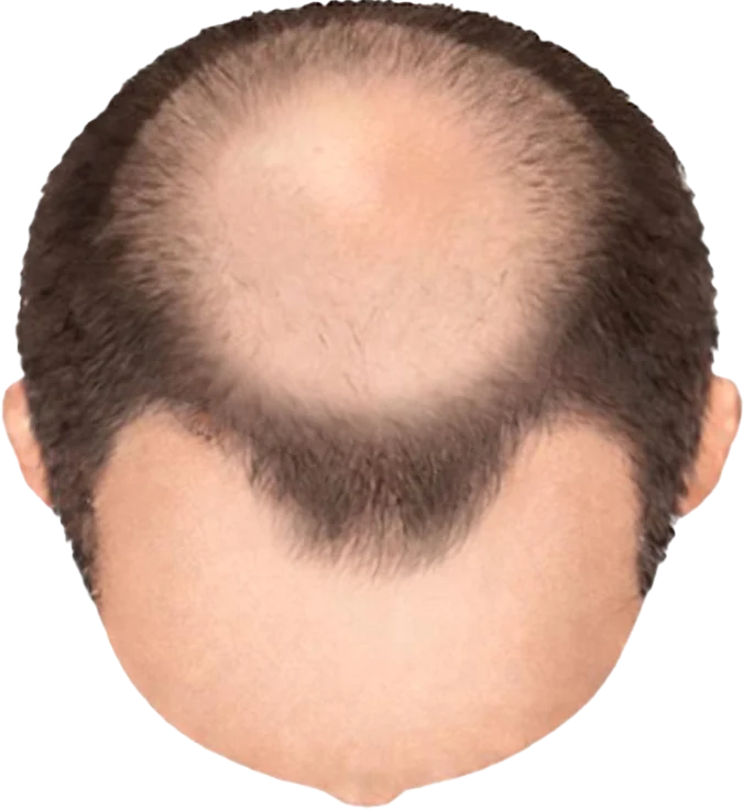 Balding Stage f2-b7