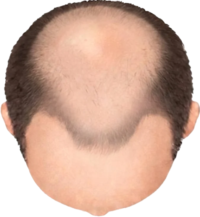 Balding Stage f2-b8
