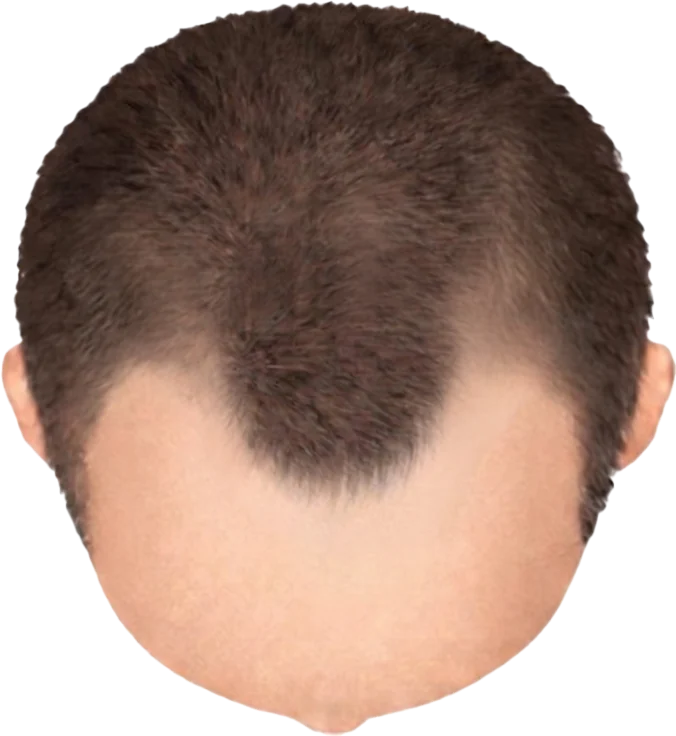 Balding Stage f3-b1