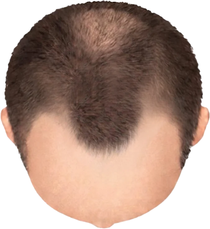 Balding Stage f3-b2