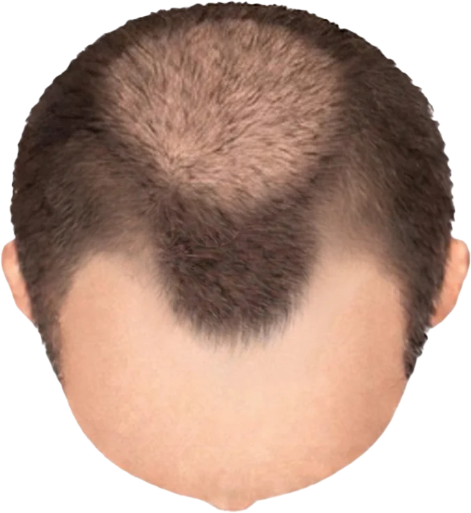Balding Stage f3-b3