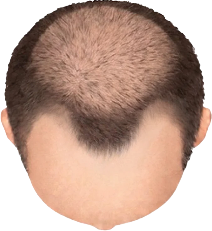Balding Stage f3-b4