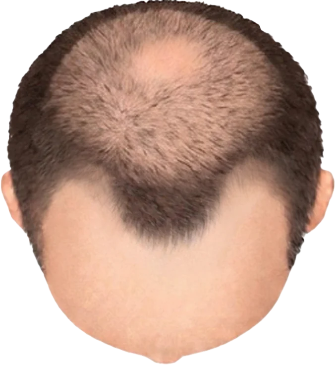 Balding Stage f3-b5