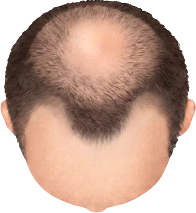 Balding Stage f3-b6