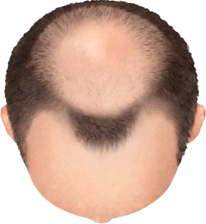 Balding Stage f3-b7