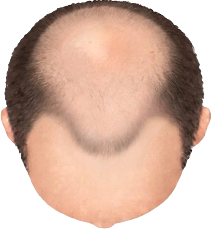 Balding Stage f3-b8