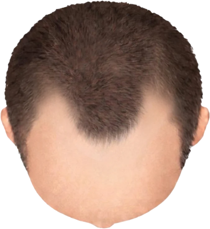 Balding Stage f4-b1