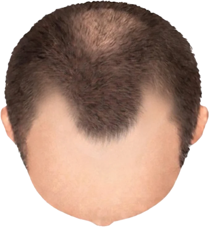 Balding Stage f4-b2