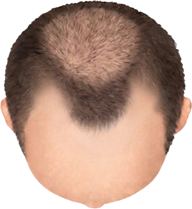 Balding Stage f4-b3