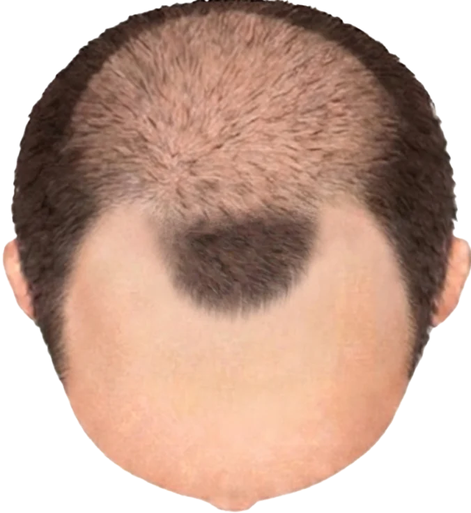 Balding Stage f4-b4