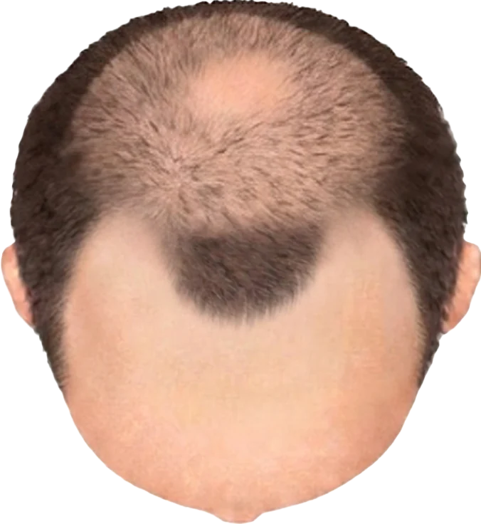 Balding Stage f4-b5