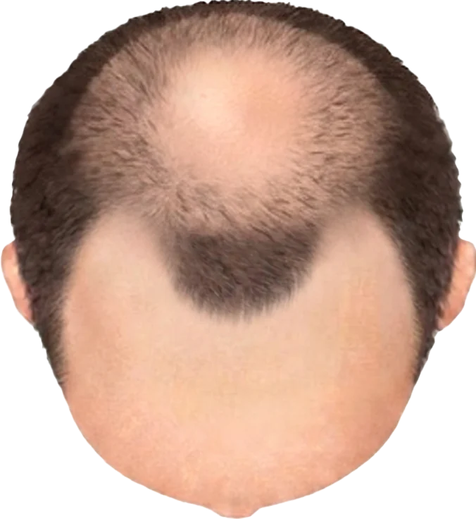 Balding Stage f4-b6