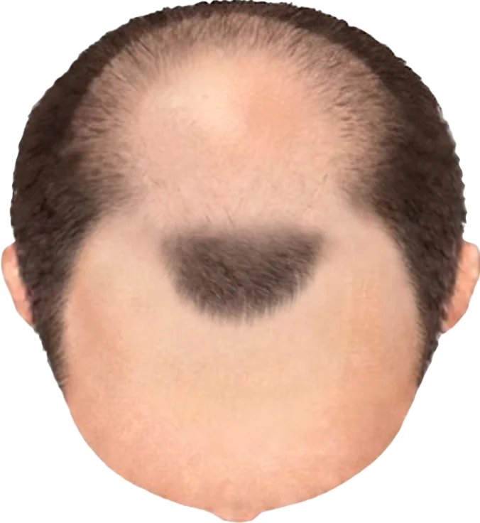 Balding Stage f4-b7