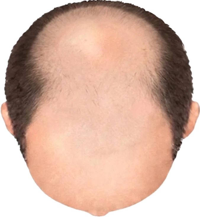 Balding Stage f4-b8