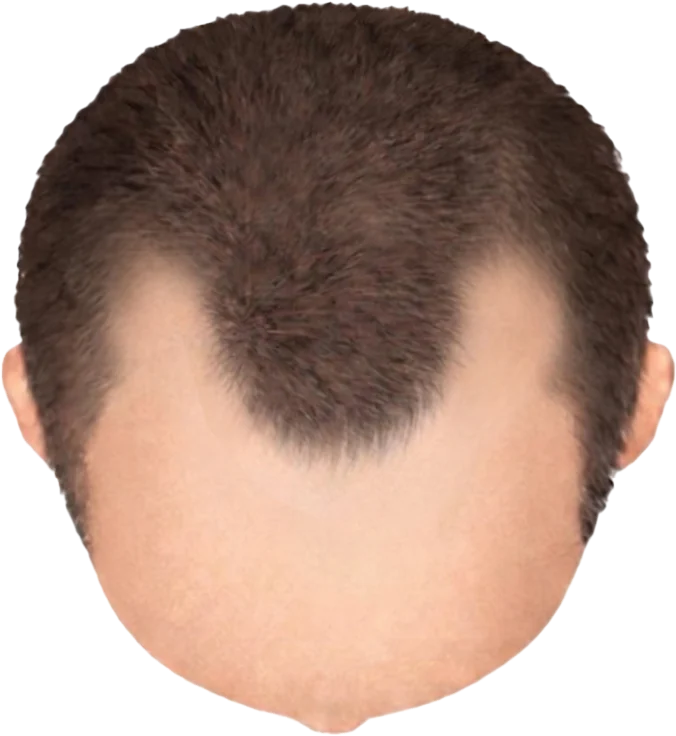 Balding Stage f5-b1
