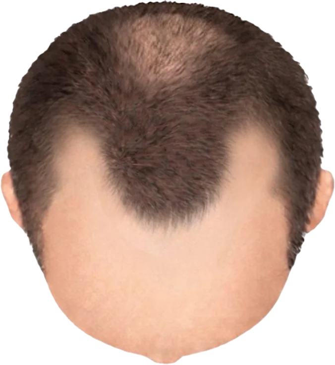 Balding Stage f5-b2