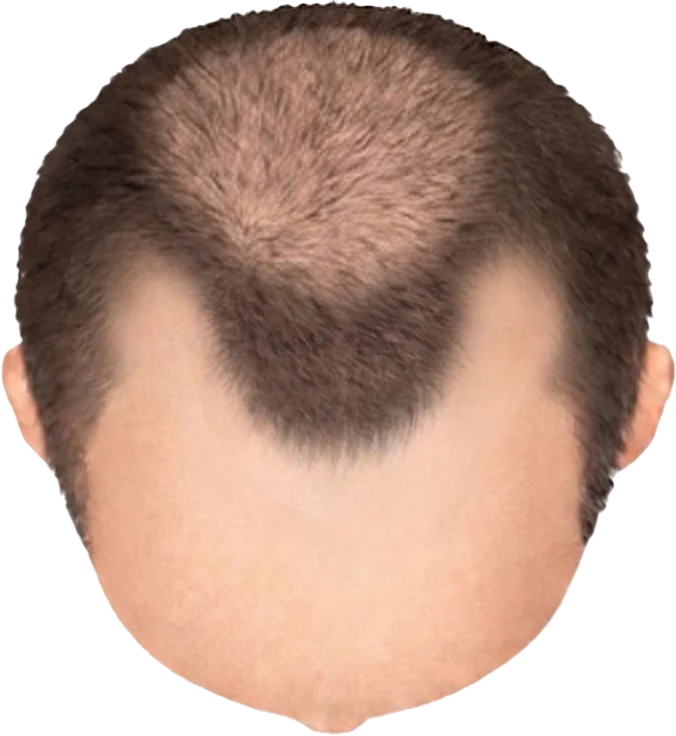 Balding Stage f5-b3