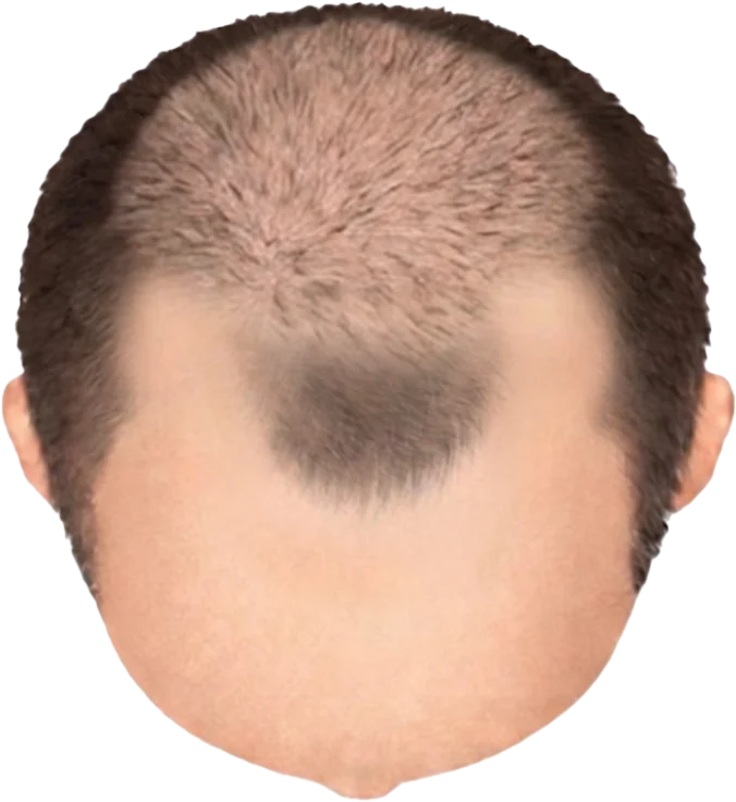 Balding Stage f5-b4