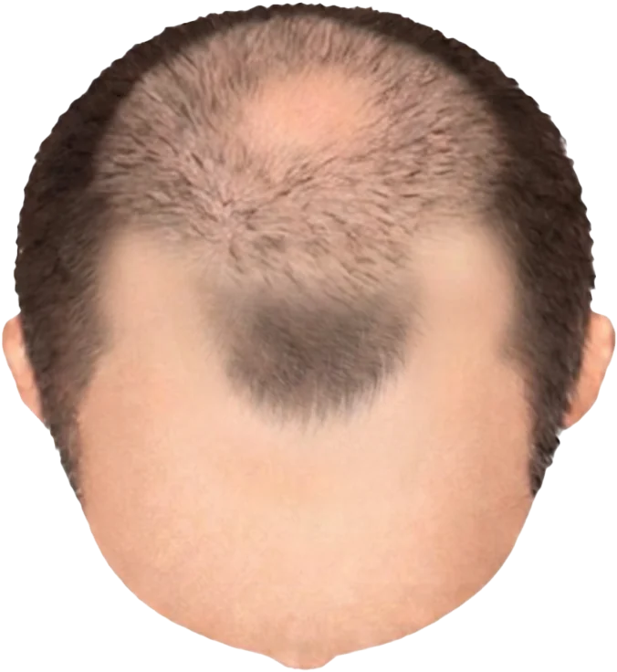 Balding Stage f5-b5