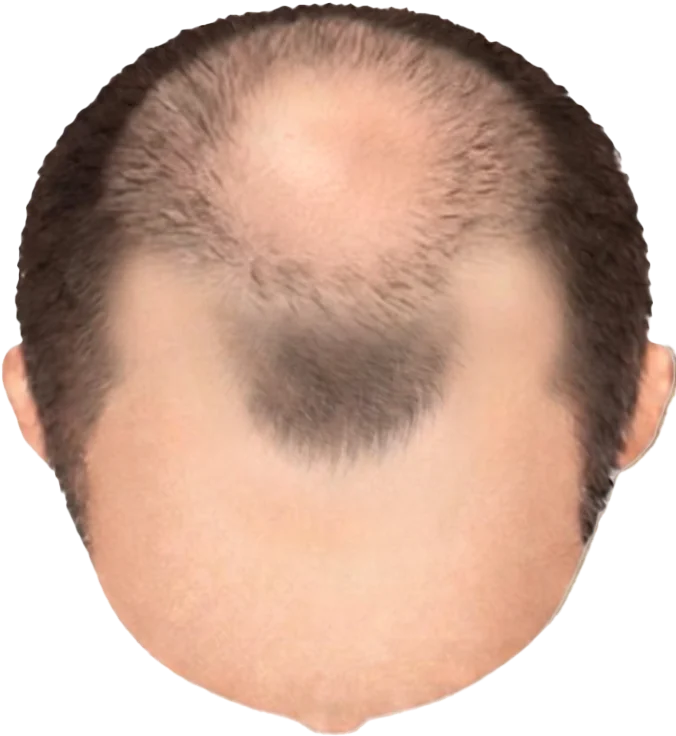 Balding Stage f5-b6