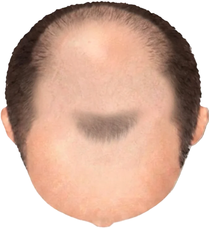 Balding Stage f5-b7