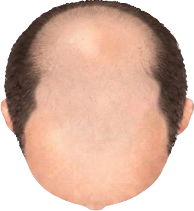 Balding Stage f5-b8