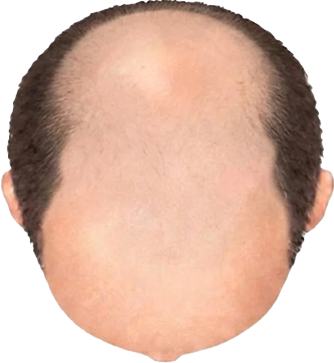 Balding Stage f5-b9
