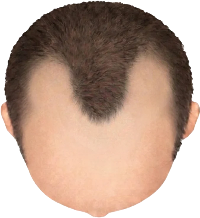 Balding Stage f6-b1