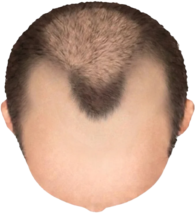 Balding Stage f6-b3