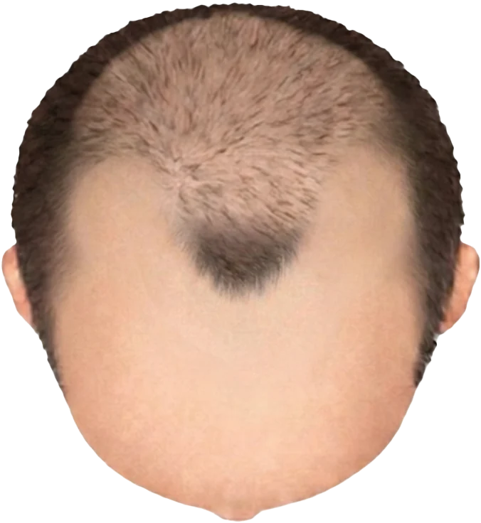 Balding Stage f6-b4